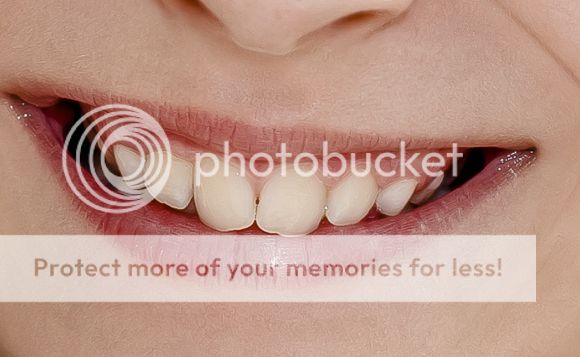 Pemutihan Gigi Dengan Metoda Pelapisan Email Gigi (Porcelain Veneers) Pemutihan Gigi Dengan Metoda Pelapisan Email Gigi (Porcelain Veneers)